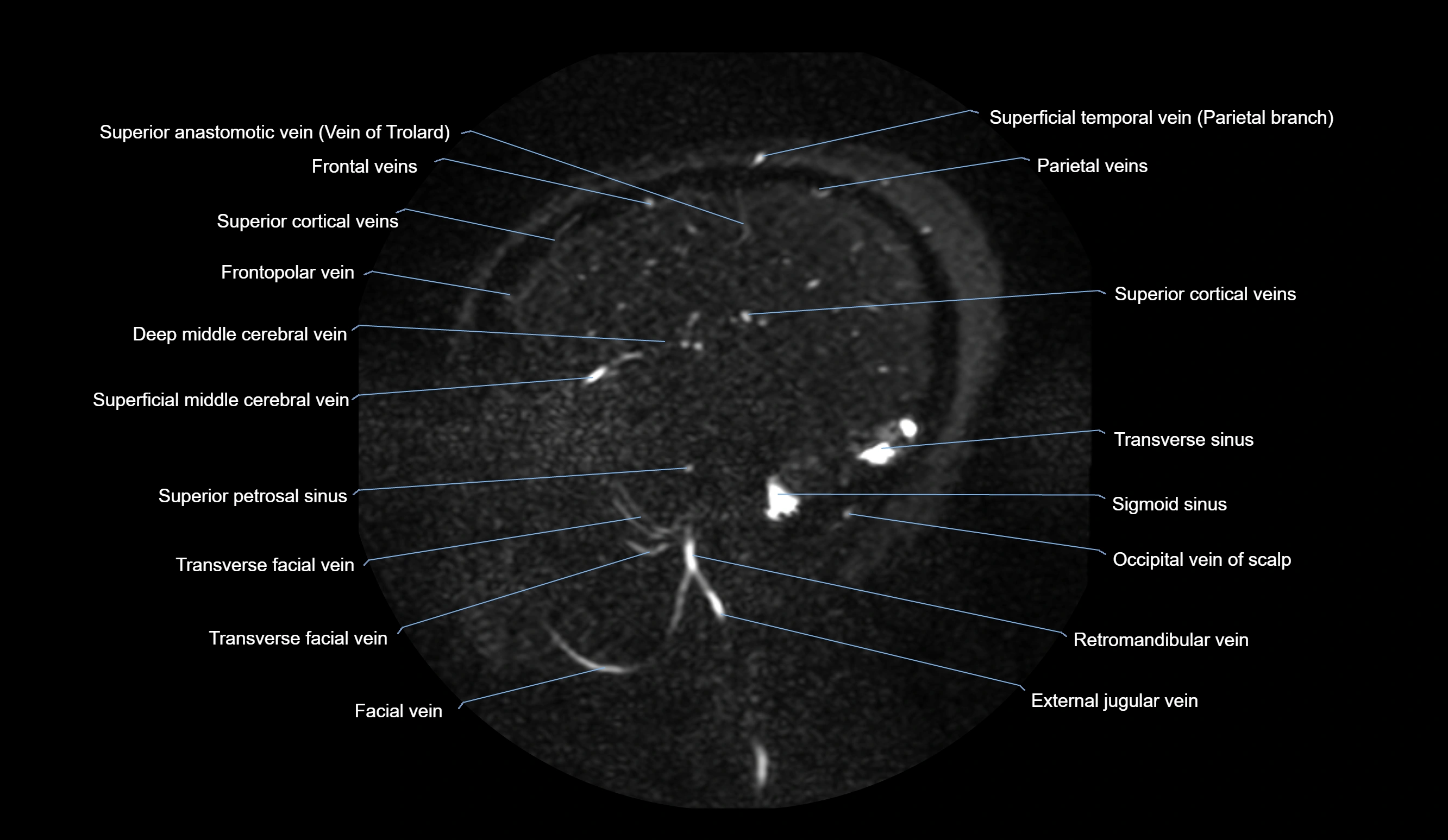 MRV brain sagittal anatomy 3T MRI labelledimages -00020.webp